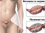 СПКЯ и беременность