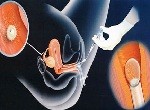 Искусственная инсеминация: характеристика и показания