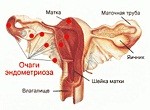 Диагностика и лечение эндометриоза яичника