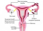 Хронический эндометриоз